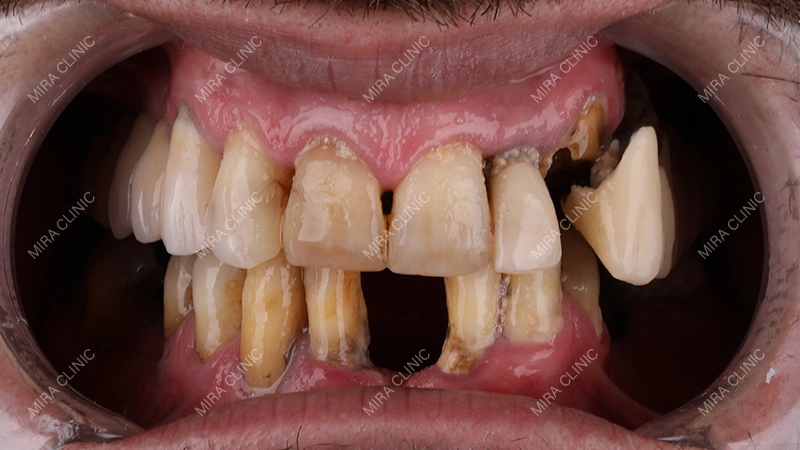 13 teeth affected by decay